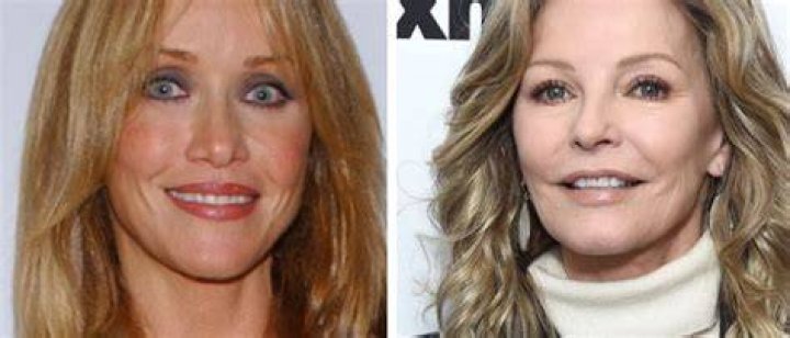 Cheryl Ladd Plastic Surgery – Botox And Lip Fillers, Before And After Photos Explored