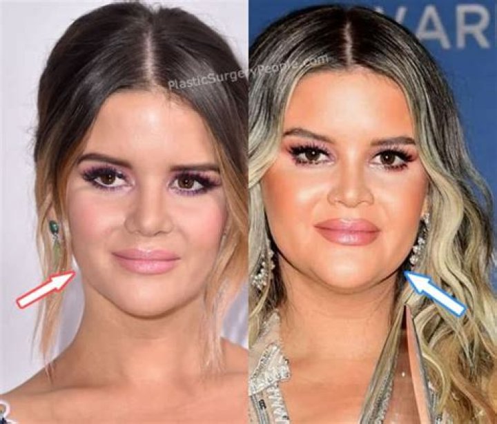 Did Maren Morris Get Botox? Here Is What The Singer Looks Before & After Plastic Surgery