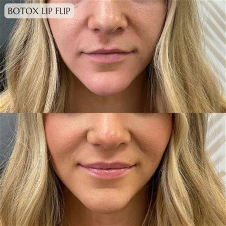 
Did Sofia Vergara Undergo Botox And Lip Fillers? Plastic Surgery Rumors Addressed! 