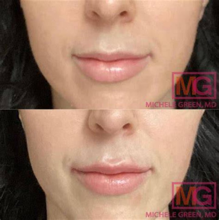 
Emily Ratajkowski Plastic Surgery – Fans Suspect Botox And Lip Filler! 