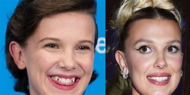 
How Did Millie Bobby Brown Look Before And After Plastic Surgery? 